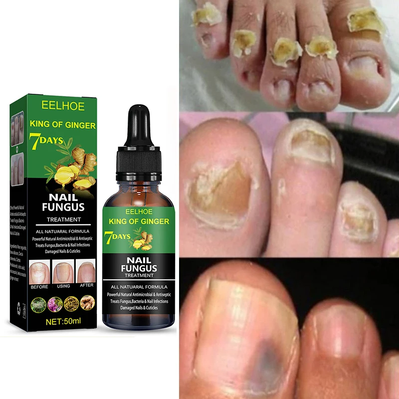 

50ml Nail Fungal Treatment Feet Care Essence Anti Infection Paronychia Onychomycosis Nail Foot Toe Nail Fungus Removal Gel