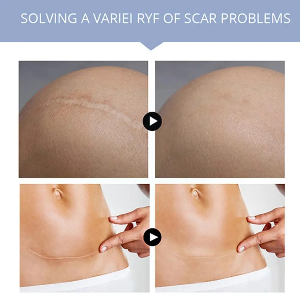 

50pcs Scars Remover Non-irritating Body Cream Dropshipping N2n1