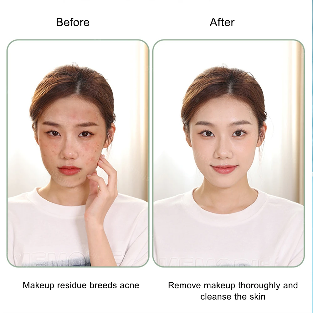 Средство для удаления черных точек средство очистки устройство сужения пор