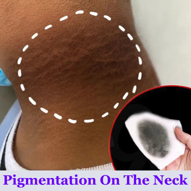 Отбеливающий крем для интимных частей подмышек отбеливание ягодиц коленей