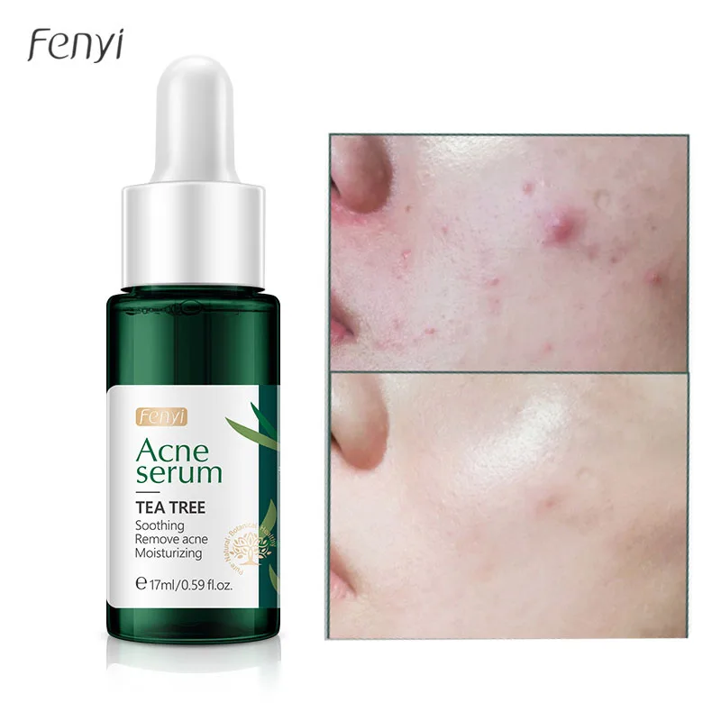 Tea Tree Acne Serum Remove Pimples Anti Acne Treatment Moisturizing Soothing Sensitive Skin Oil Control Whiten Repair Acne Marks