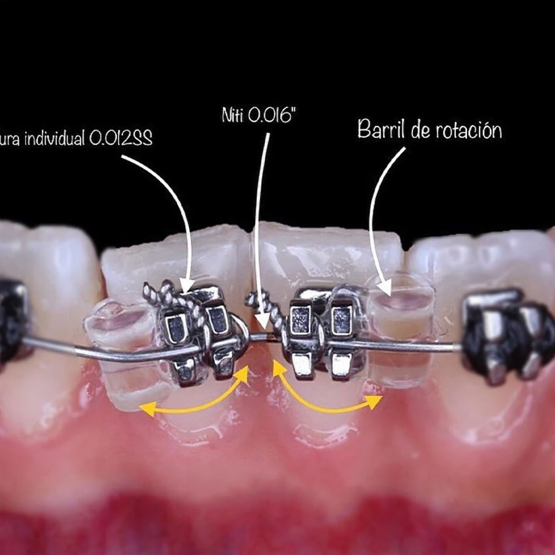 Рисунок 5 - Стоматологические Ортодонтические вращающиеся клинья