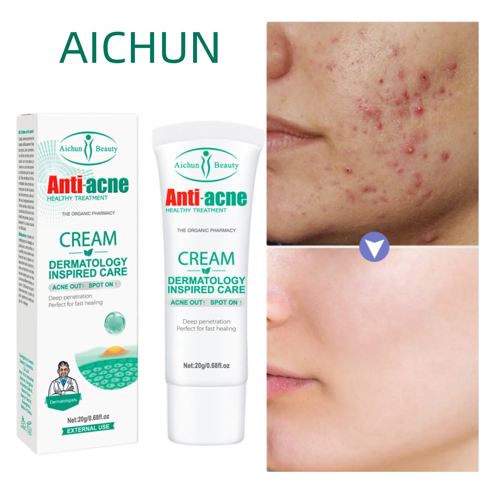

Salicylic Acid Acne Face Cream Whitening Pimple Spots Black Dots Removal Fade Acne Marks Shrink Pores Treatment Health Skincare
