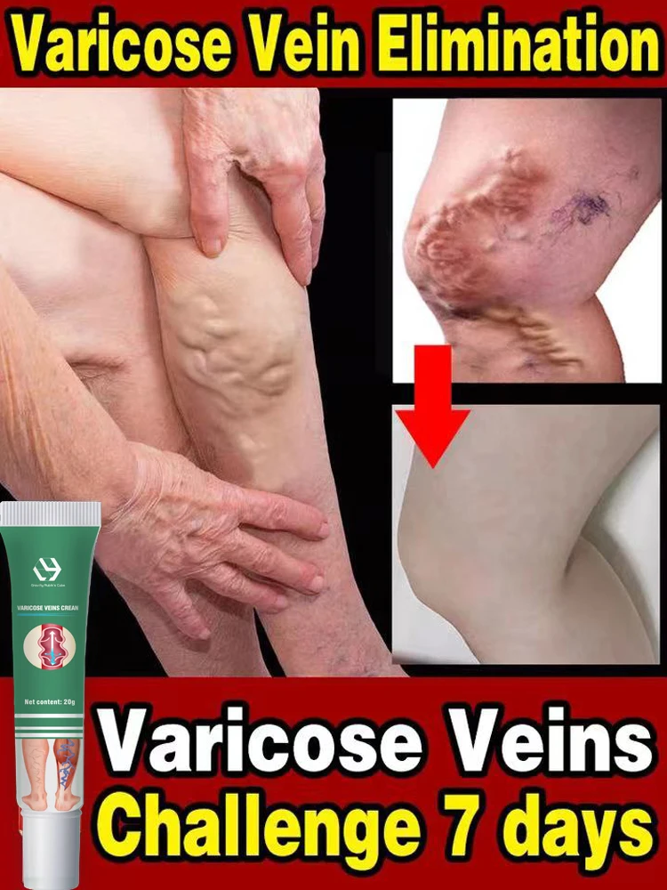 

Effective Varicose Vein Relief Cream Ointment For Varicose Veins To Relieve Vasculitis Phlebitis Spider Pain Treatment