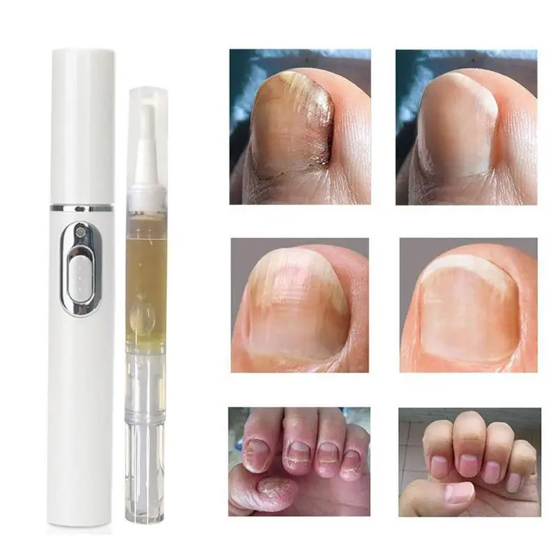 

Blue Light Nail Repair Pen Nail Nutritious Oil Anti Restores Healthy Toenails Repair Solution