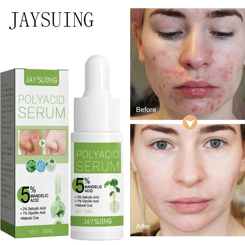 

Эффективное удаление акне эссенция осветление акне отметка усадка поры уход за кожей лица контроль жирности Отбеливающая увлажняющая Восс...