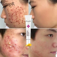effective acne removal cream acne treatment repair oil control shrink pores scar face skin care whitening beauty health creams