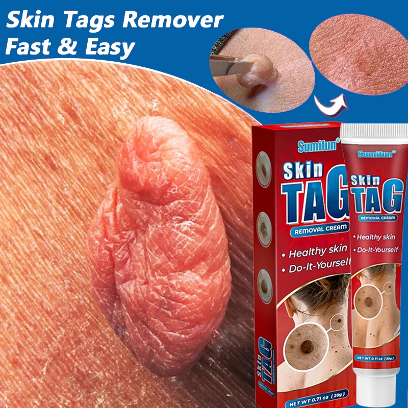 

Wart Remover Cream Clean Painless Mole Skin Dark Spot Warts Remover Face Wart Tag Treatment Men Women Serum Cream