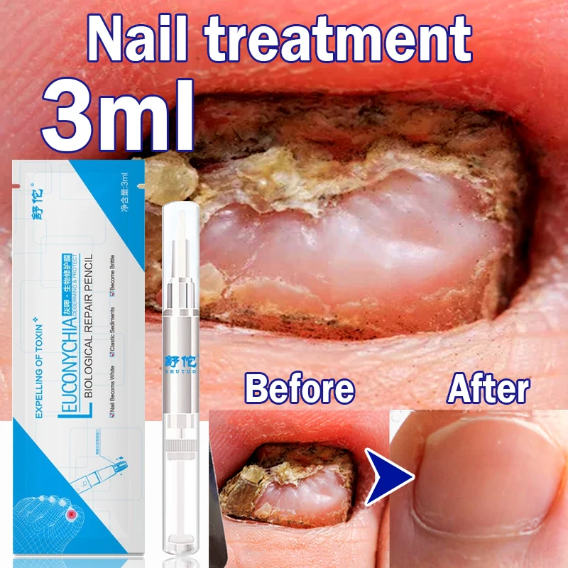 

Nail Fungal Treatment Pen Anti Fungus Infection Biological Repair Solution Nutritious Oil 3ml Restores Healthy Toenails