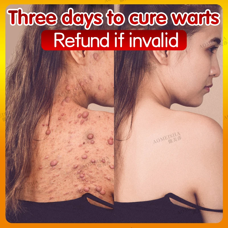 

Wart Removal Balm Clean Painless Mole Skin Dark Spot Wart Remove Facial Wart Tag Treatment