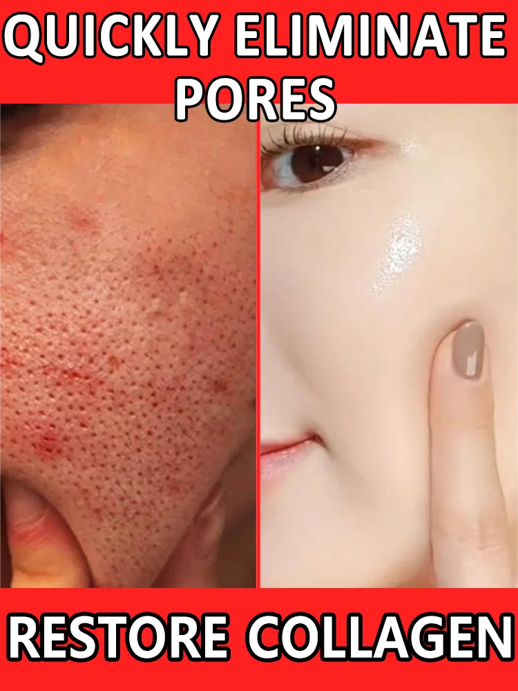 Очистите кожу удалите прыщи угри очистите грязь и уменьшите чрезмерное