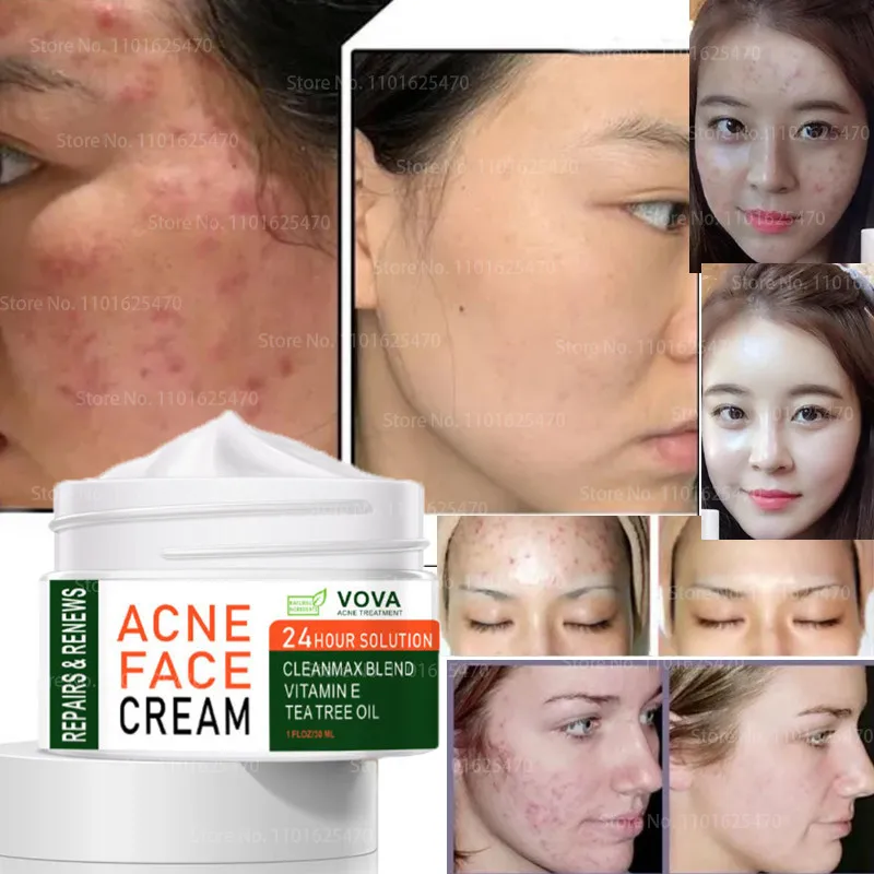 

30ml Effective Herbal Anti-acne Cream Freckle Oil Control Skin Care Moisturizing Whitening Facial Gel To Smooth The Skin Care