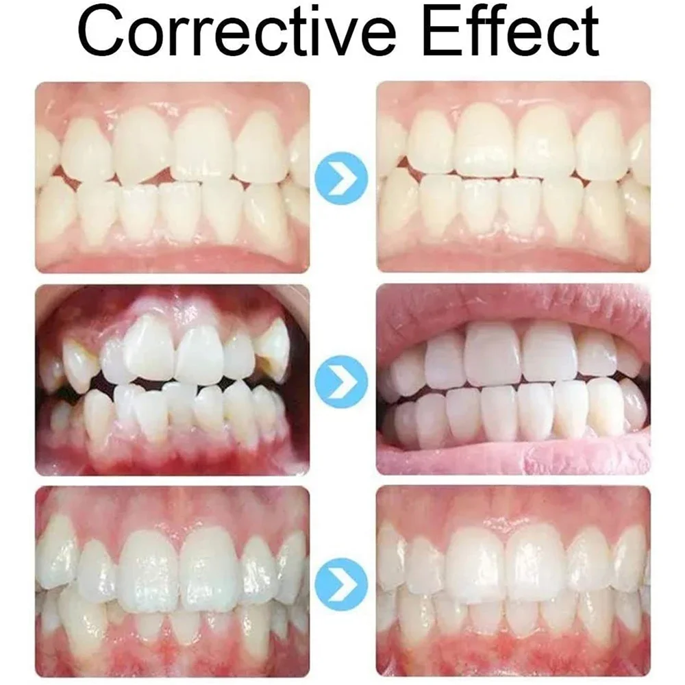 Sdottor 3 этапа силиконовые зубы невидимый ортодонтический набор стоматологические