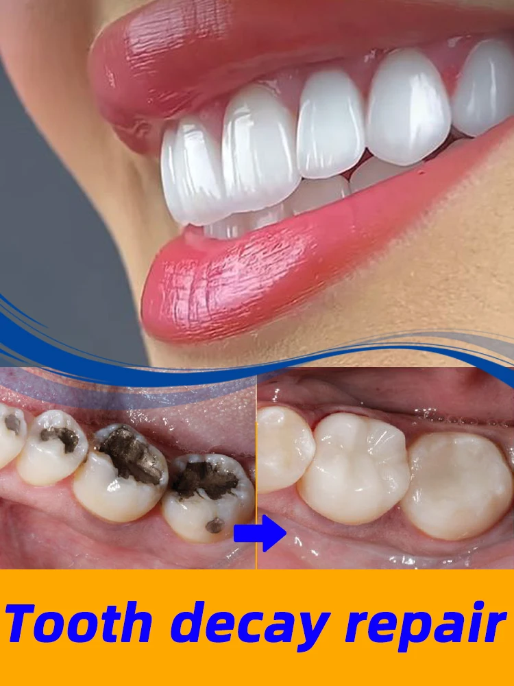 Хит продаж мусс для удаления кариес