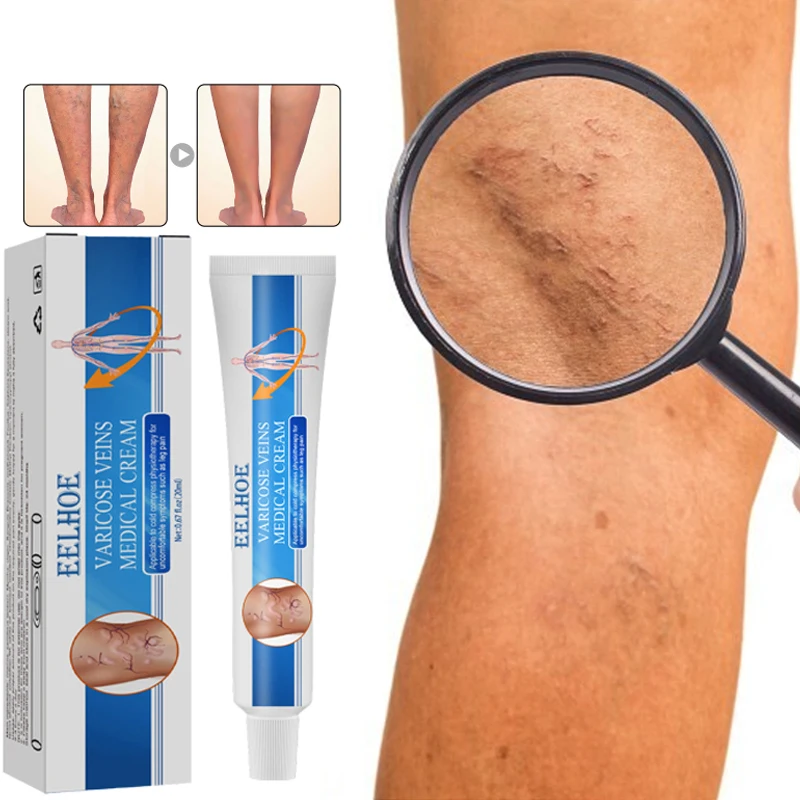 

Sdotter ointment varicose veins Leg swelling varicose vein relief massage cream relieve vasculitis phlebitis spider bulging pain