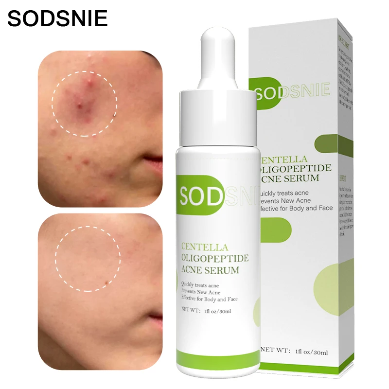 

Centella Acne Serum Remove Pimples Moisturize Shrink Pores Oil Control Anti-Inflammatory Acne Treatment Brighten Skin Care 30ml