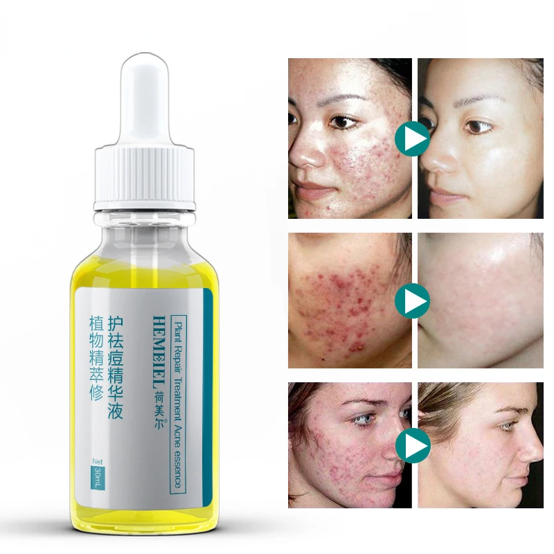 

30ml plant acne-removing essence mildly repairs acne pits acne marks acnes blackheads shrinks pores hydrating original liquid