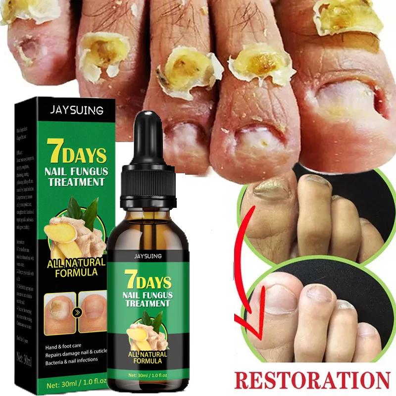 

7 Days Ginger Nail Fungal Treatment Serum Anti Infection Remove Hand Foot Onychomycosis Paronychia Repair Damaged Nail Feet Care