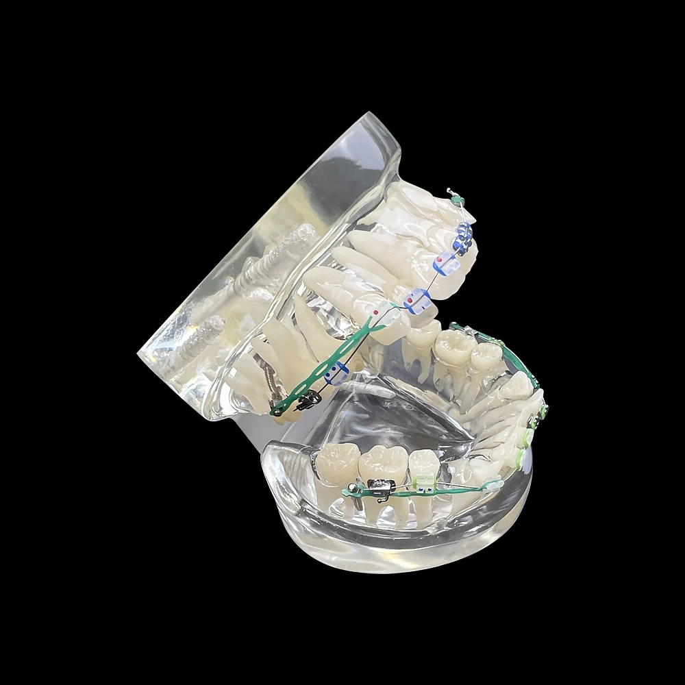 Ортодонтическая модель зубов с металлическими и керамическими звеньями