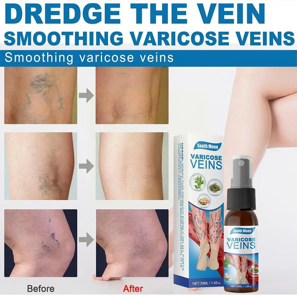 

Varicose Veins Spray Medicine Spider Veins Treatment Relief Phlebitis Vasculitis Relief Medical Care 30ml Pain Spider Plast Y6d7