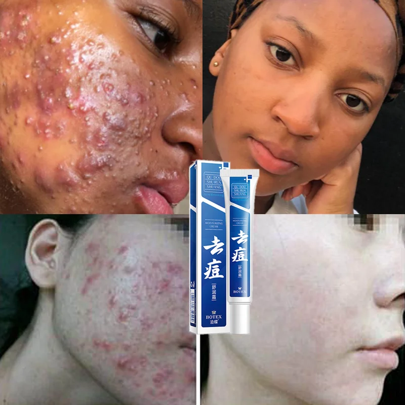 Herbal Acne Removal Cream Effective Pimple Scar Treatment Oil Control Shrink Pore Moisturizing Face Serum Beauty Health SkinCare