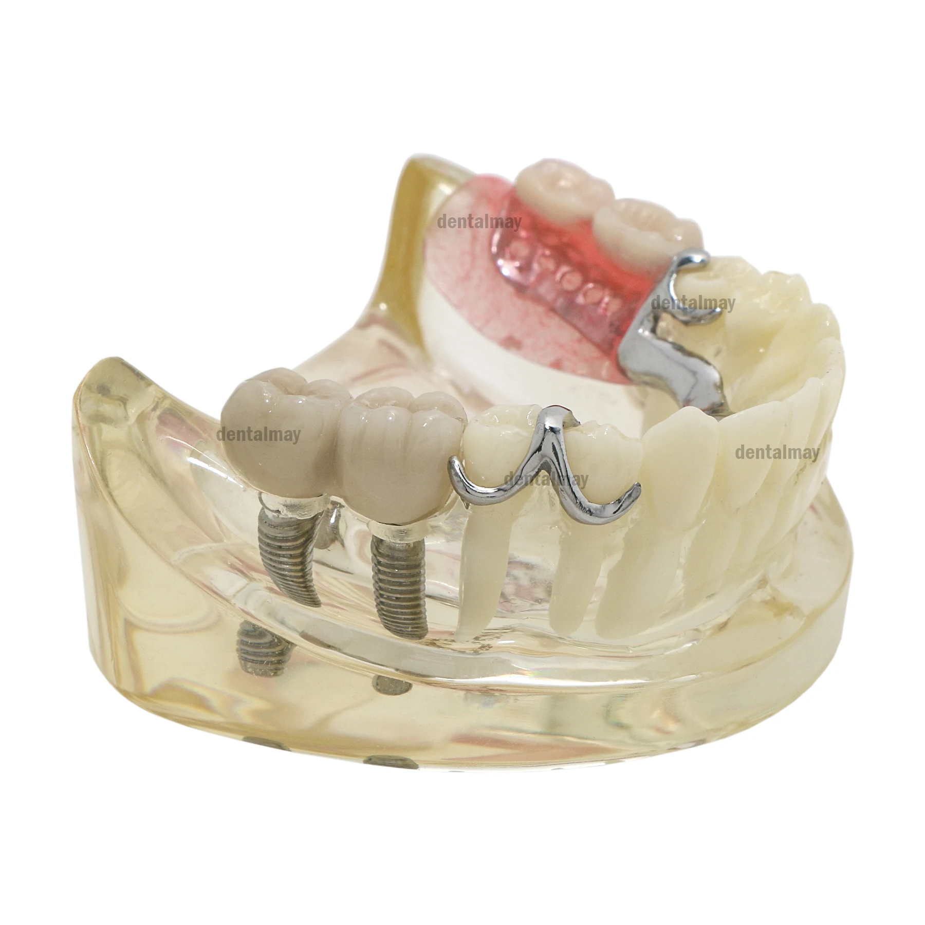 Реставрация зубного имплантата Модель зубов Typodont с частичным зубным протезом M6022