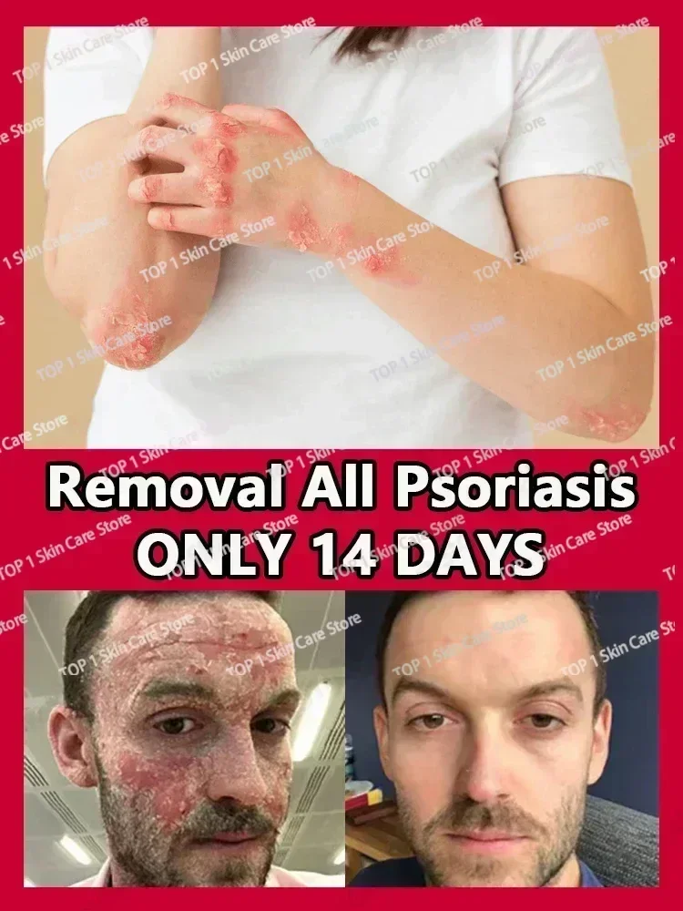 Натуральный растительный экстракт для удаления псориаза от дерматита