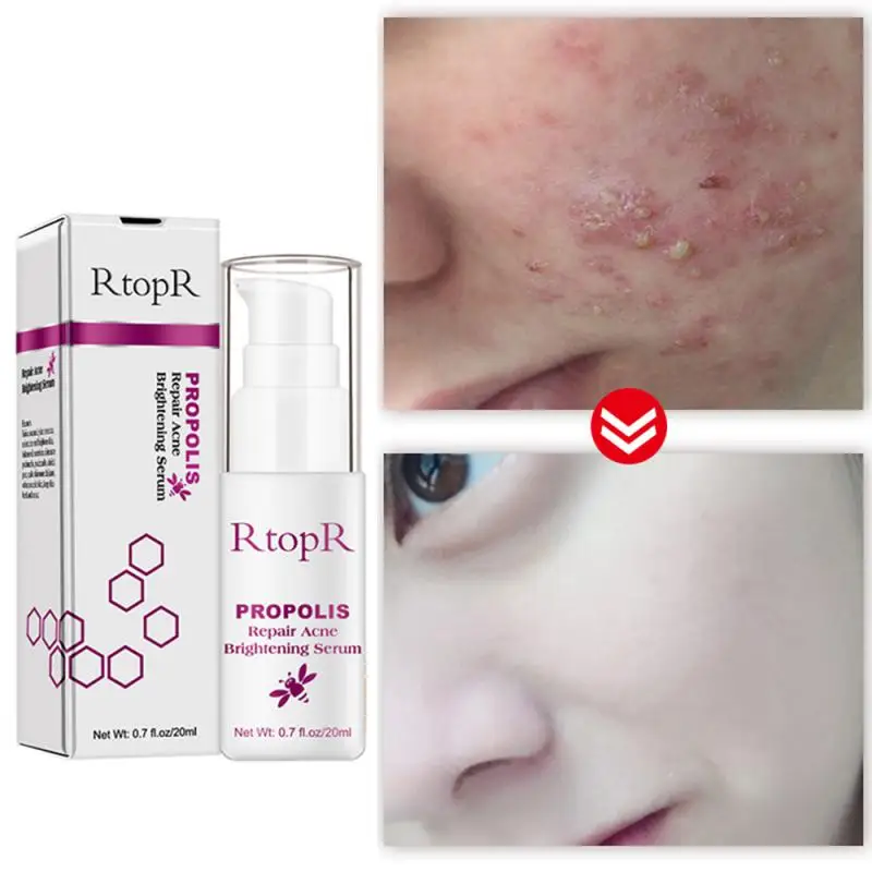

20ml Propolis Repair Acne Brightening Serum Acne Scar Spots Cleaning Serum Shrink Pores Acne Oil Control TSLM2