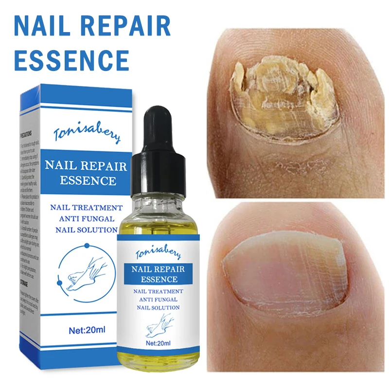 Nail Fungal Treatment Feet Care Essence Anti Infection Paronychia Onychomycosis Nail Foot Toe Nail Fungus Removal Gel Products