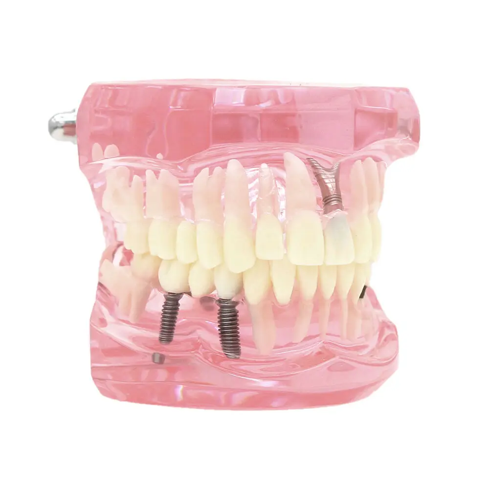 Dental Teeth Model Teach Study Oral Implant Restoration & Pathology M2001 Pink