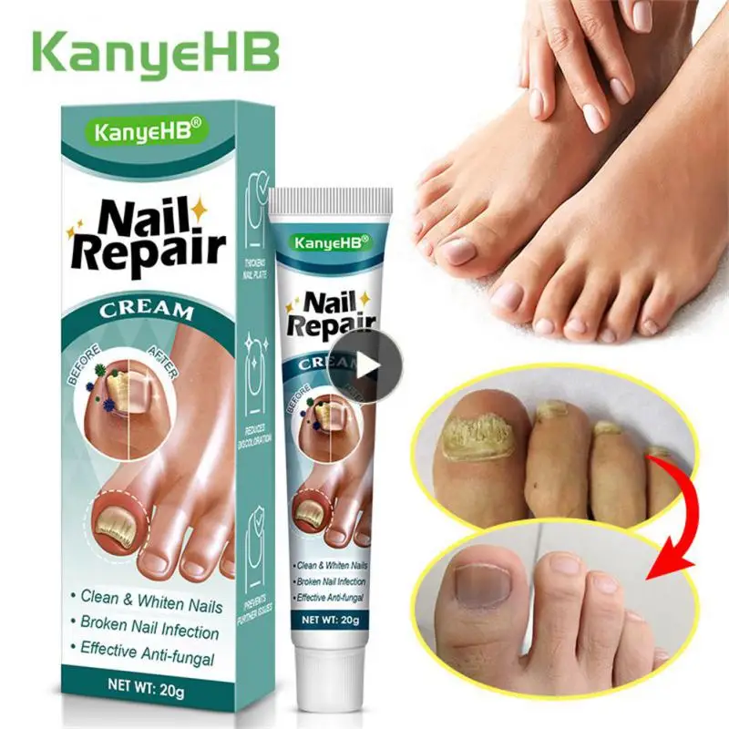 

Multifunction Onychomycosis Removal Nail Repair Lotion Toe Nail Cream Onychomycosis Repair Fingernail Cream Beauty Nail Care