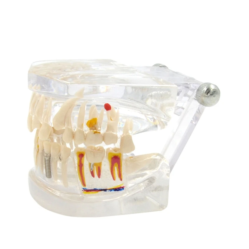 

G5AA Teeth Model with Removable Tooth Transparent Dental Implant Teeth Model for disease Teeth Study Dentist Office