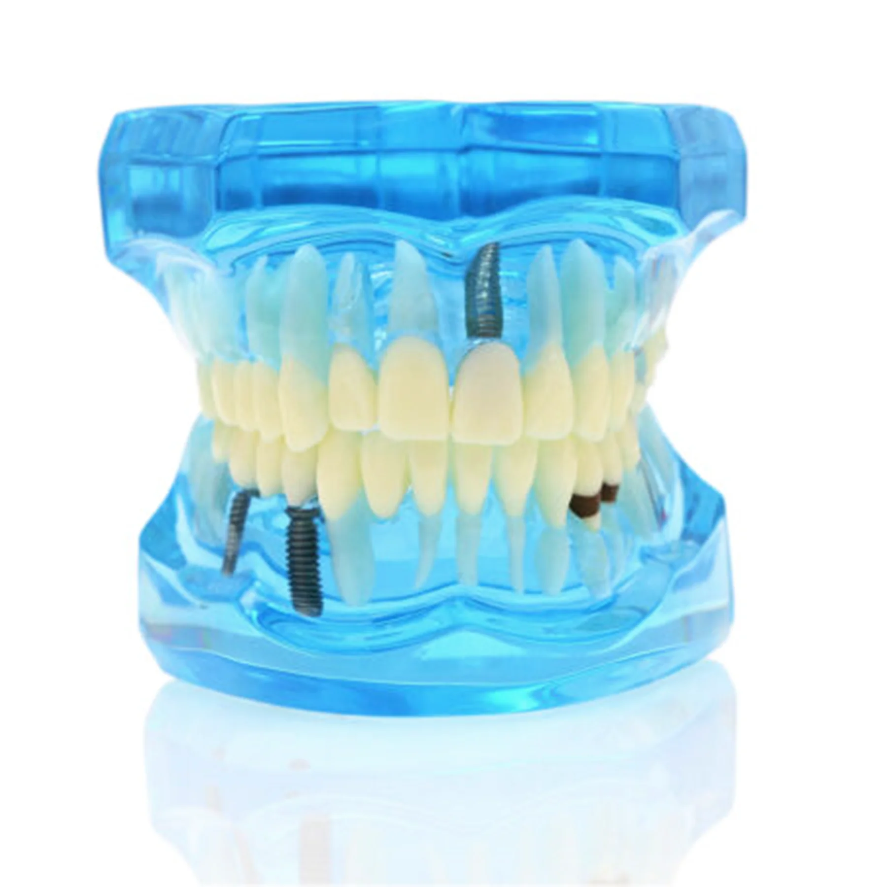 

Dental Teeth Tooth Model Implant Restoration Typodont Demo Oral Pathology Bridge Teach Study M2001 Blue Color