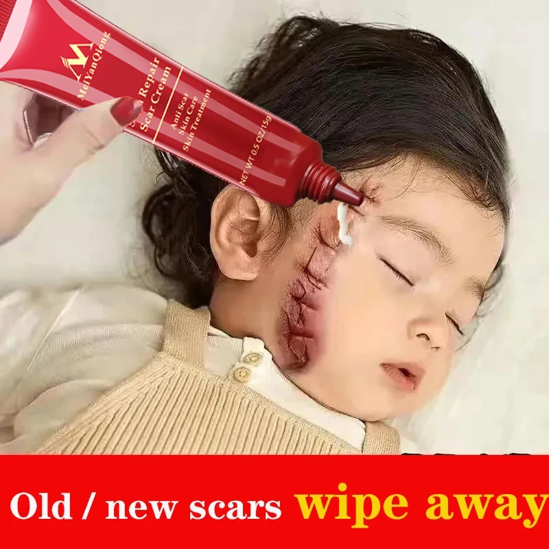 

10 шт., мазь для удаления шрамов от акне, 15 г