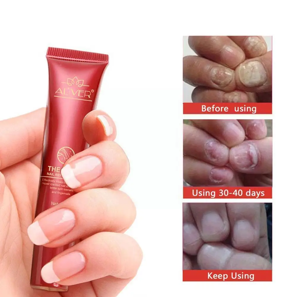 

15 мл Aliver средство для лечения грибка ногтей, инструменты для восстановления и ухода за ногтями, крем для ухода за ногтями Onychomycosisnail, крем для ...