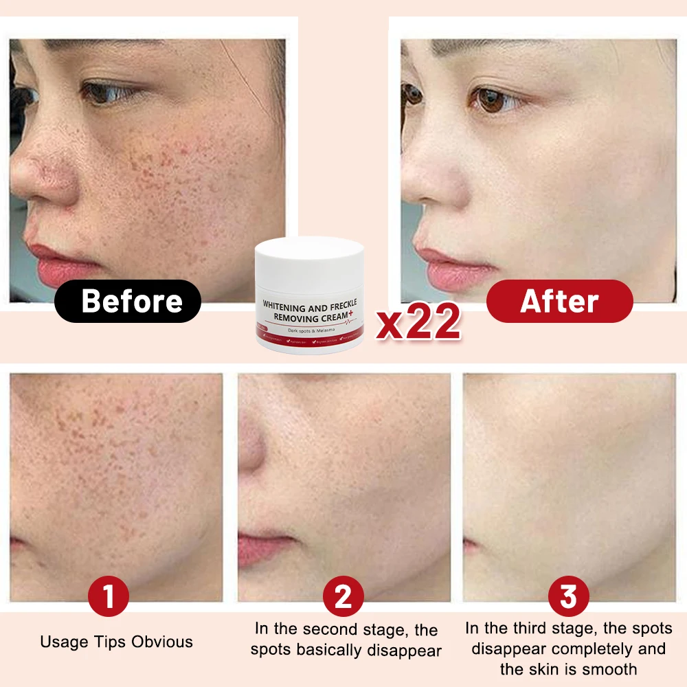 Отбеливающий и крем против веснушек удаляет темные пятна солнечные