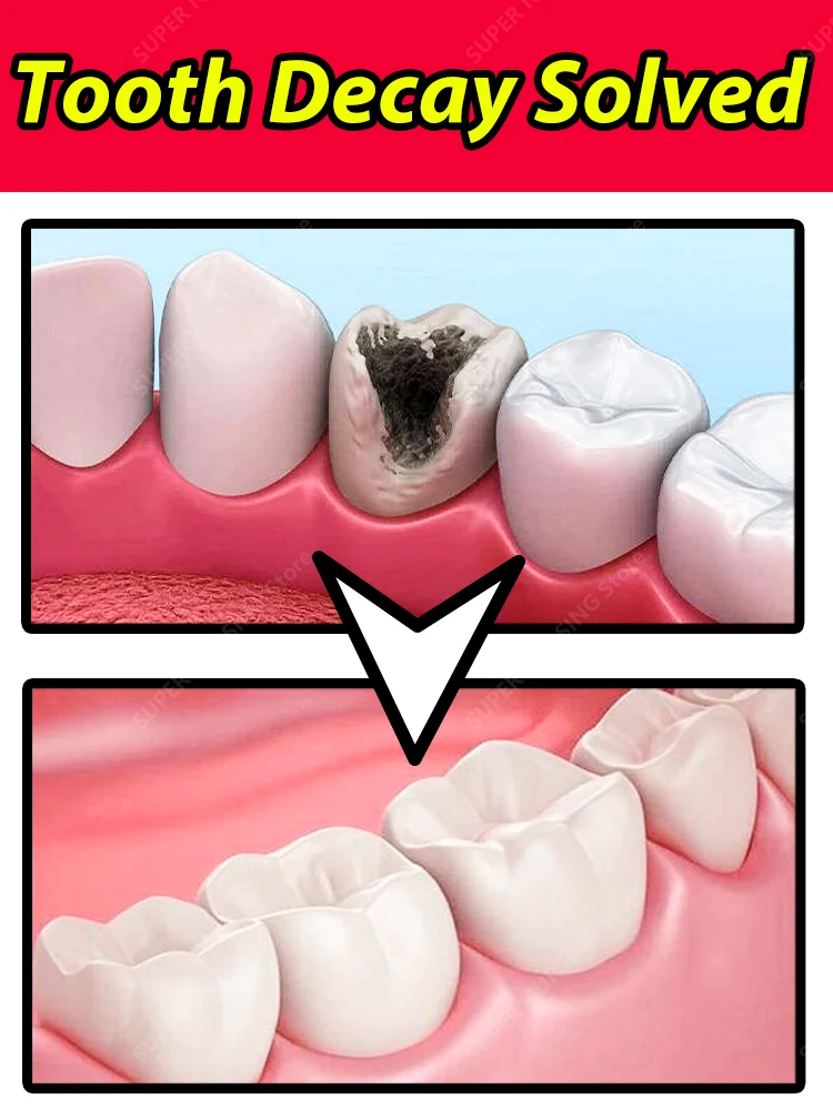 Зубный карь ремонт полостей защита от кариеса