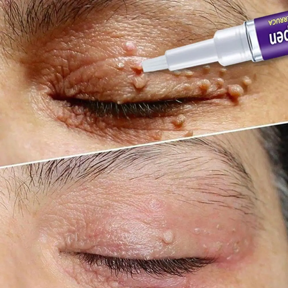 

Removal Genital Wart Treatment Papillomas Skin Tags Effective Moles Anti Removing Remedy Against Remover Rapidly Verruca V0C4