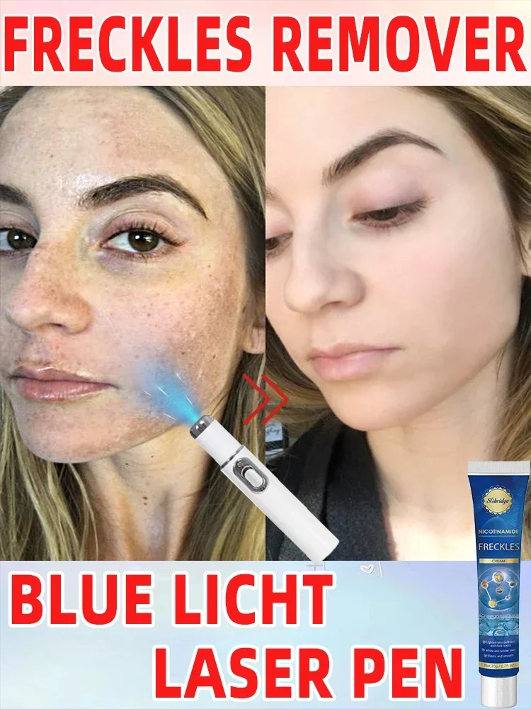 Лазер от солнца темные пятна веснушки уменьшение хлоазмы