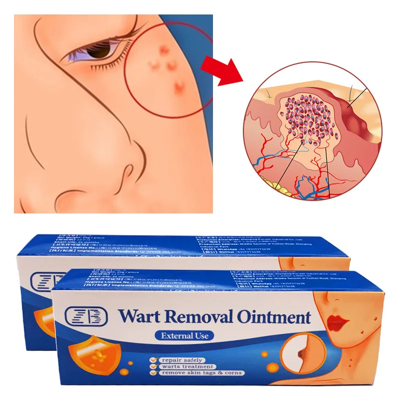 

3pcs Zb Gram Wart Cream Antibacterial Herbal Balm Flat Wart Papilloma Remove Ointment Antibacterial Disinfection Skin Care