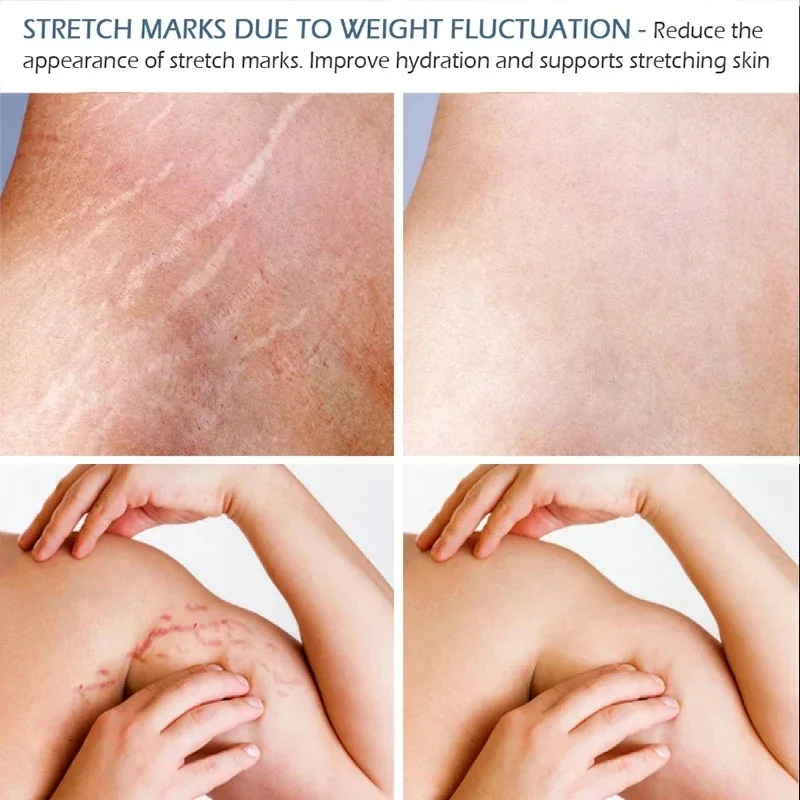 Восстанавливающий Крем для растяжек 20 г