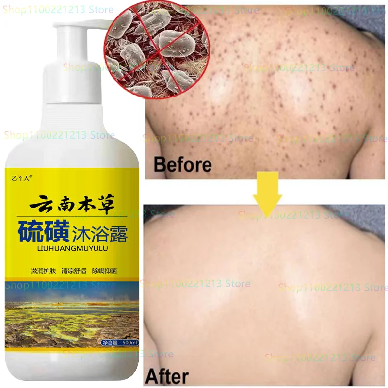 

Сера полынь для мытья тела Urticaria аллергенное облегчение зуда дерматит экзема удаление акне удаление клещей тела