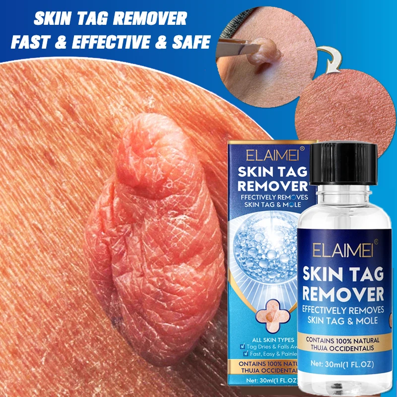 

Skin Tag Remover Liquid Painless Mole Skin Dark Spot Papillomas Foot Corn Body Face Flat Wart Meat Granules Treatment Serum 30ml