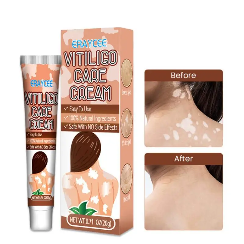 

Лечение Vitiligo для кожи Vitiligo крем для ухода за Vitiligo для уменьшения белых пятен и улучшения пигментации кожи уход за кожей