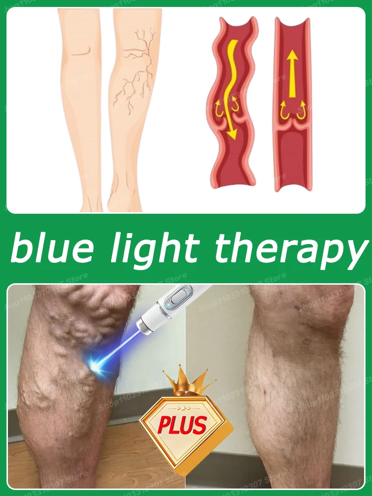 Ручка Varicosse Blu-ray Skin Cream