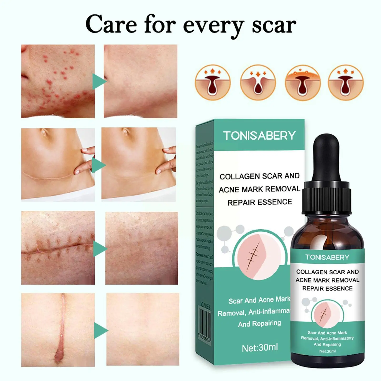 

Эффективное удаление шрамов эфирными маслами, растяжек, пятен, ожогов, уход за кожей, восстановление акне, 30 мл, хирургическое лечение A1L2