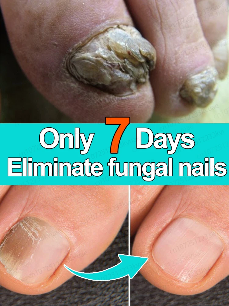 Сыворотка для ног с эфирным маслом онихомикоза, 7-дневное ...