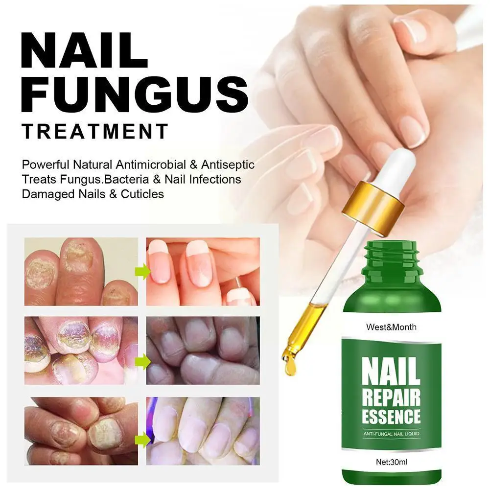 

Nail Fungal Repair Essence Serum Anti Fungal Nail Foot Infection Care Treatment Remove Onychomycosis Anti Nourishing Gel To Q0H3