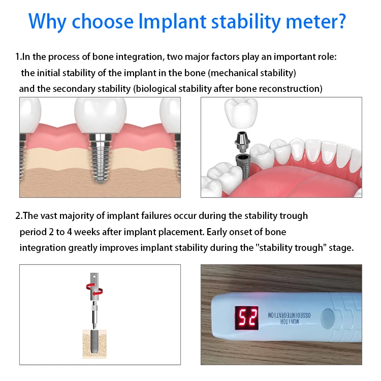 Ден Таль Измерение Стабильность Импа lant Инструмент Güven Tor Osseointegration Продукты den tal