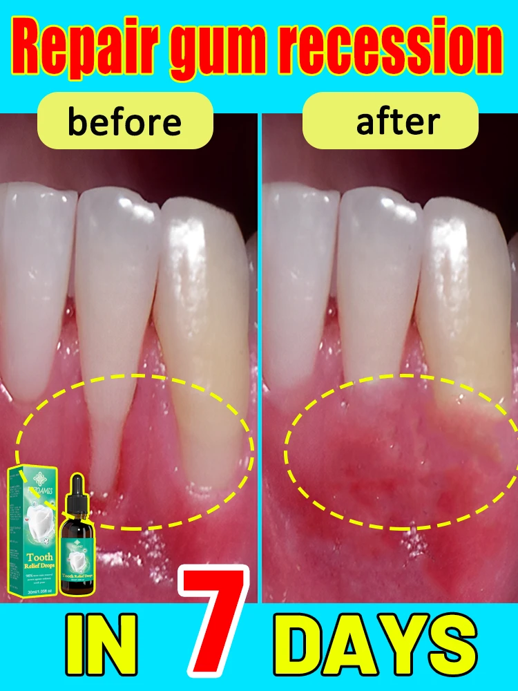 Десны успокаивающие капли заставляют десны расти выше бриллианты. Попрощайтесь